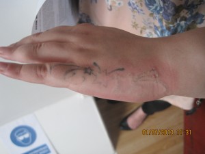 Laser removal of tattoo on arm at Eerie Walsall