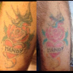 mandy laser tattoo removal West Midlands